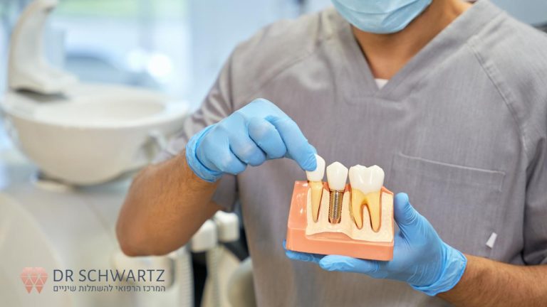 איך מתבצע תהליך השתלת שיניים - תמונה ראשית - ד״ר שוורץ