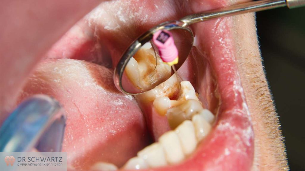 תמונה ראשית - טיפול שורש - מרפאת השיניים דר שוורץ בנתניה