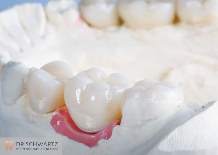 תמונה ראשית - מיקום השן - מרפאת השיניים דר שוורץ בנתניה