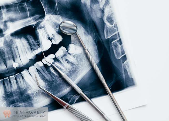 תמונה ראשית - ניתוח שחזור - מרפאת השיניים דר שוורץ בנתניה