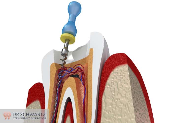 תמונה ראשית - סוג הטיפול - מרפאת השיניים דר שוורץ בנתניה