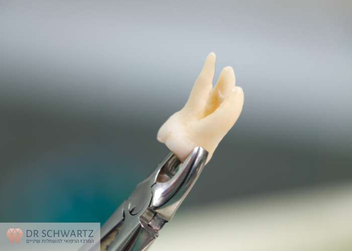תמונה ראשית - עקירת שיני בינה - מרפאת השיניים דר שוורץ בנתניה