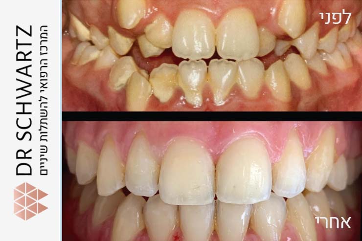 יישור שיניים עם סמכים - לפני ואחרי