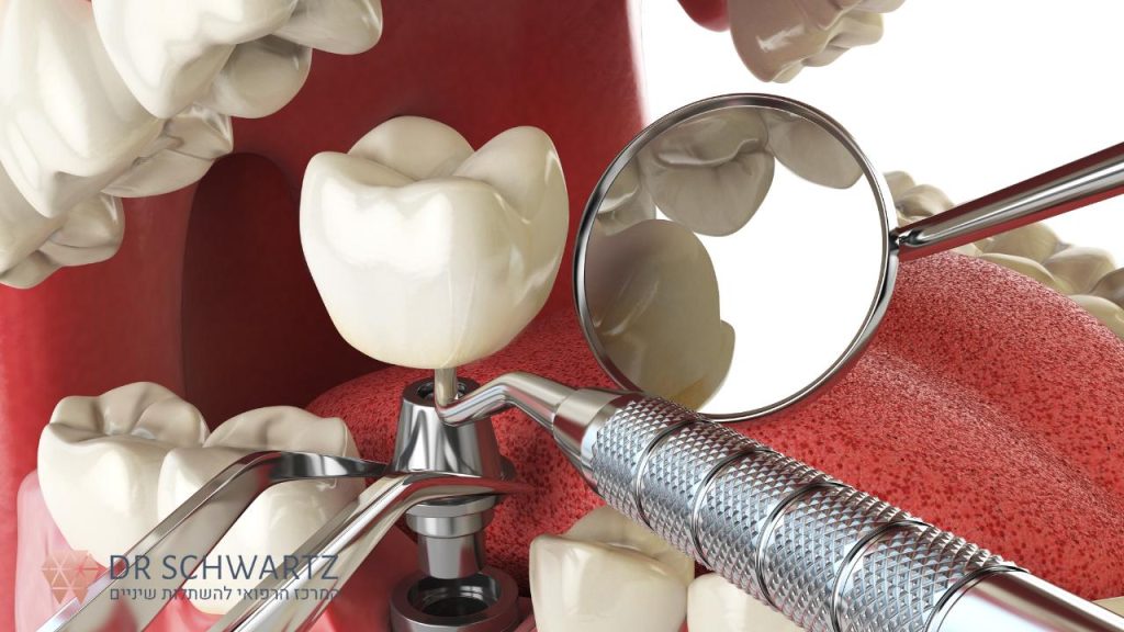 השתלות שיניים ממוחשבות - תמונה ראשית - ד״ר שוורץ
