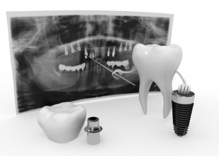 השתלות שיניים ממוחשבות - תמונה לדוגמה