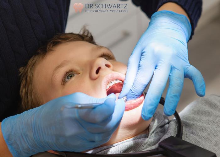 יישור שיניים לילדים - תמונה של מטופל במהלך טיפול יישור שיניים - ד״ר שוורץ