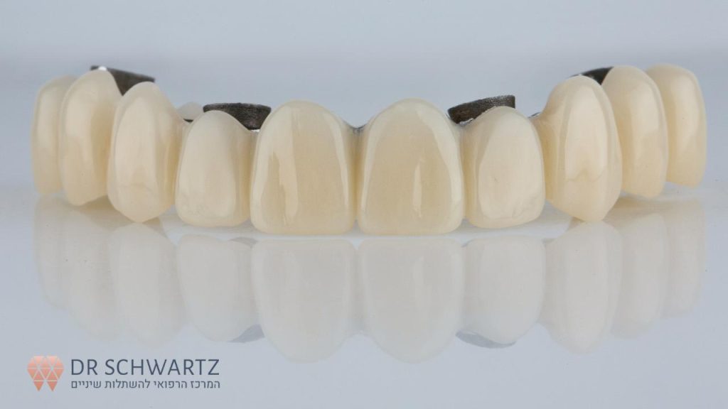 יישור שיניים ללא גשר - תמונה ראשית - ד״ר שוורץ
