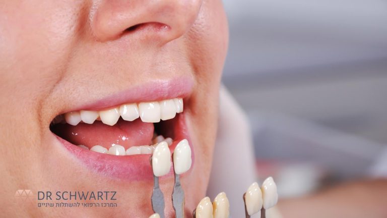 ציפוי שיניים - תמונה ראשית - ד״ר שוורץ