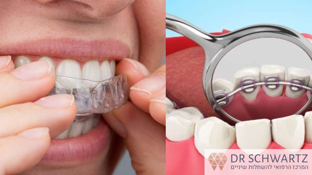 מה ההבדל בין יישור שיניים פנימי לפלטה שקופה לשיניים ד״ר שוורץ