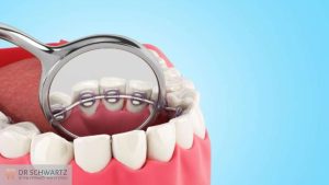 תמונה ראשית - יישור שיניים למבוגרים- מרפאת השיניים דר שוורץ בנתניה
