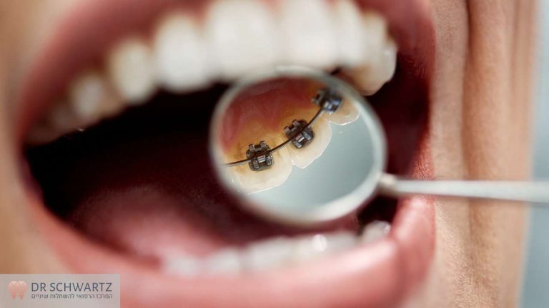תמונה ראשית - יישור שיניים פנימי - מרפאת השיניים דר שוורץ בנתניה