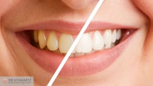 תמונה ראשית - המדריך השלם להלבנה והבהרת השיניים - מרפאת השיניים דר שוורץ בנתניה