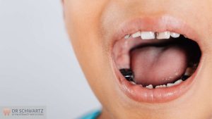 תמונה ראשית - פריאמפלנטיטיס - דלקת לאחר השתלת שיניים - מרפאת השיניים דר שוורץ בנתניה